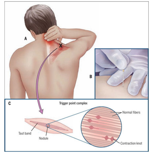 Dry Needling With Electrical Stimulation: A Pain Solution? - CityPT