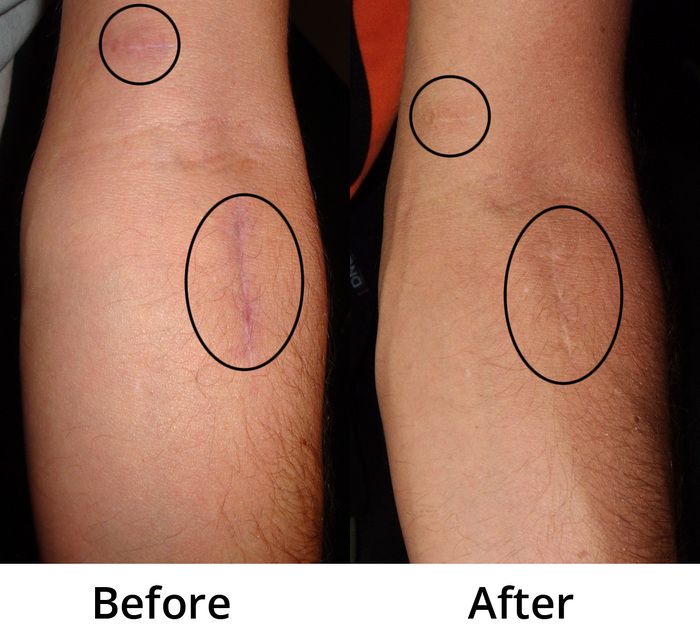 ARM Scar Before-After May 2018-GOOD – Copy OPT